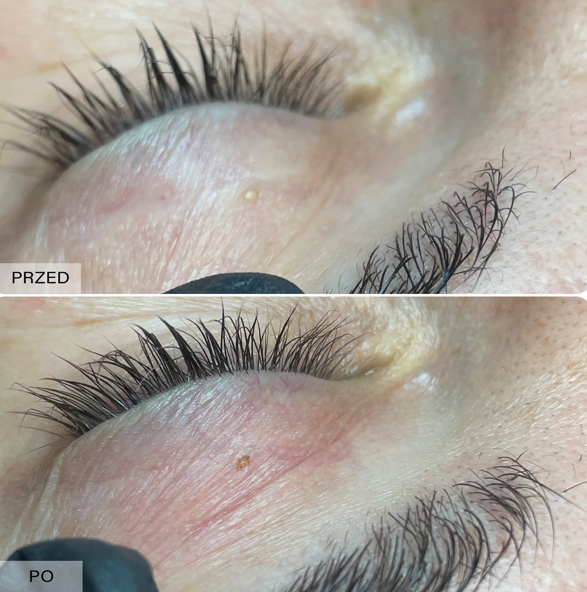 Efekt elektrokoagulacji